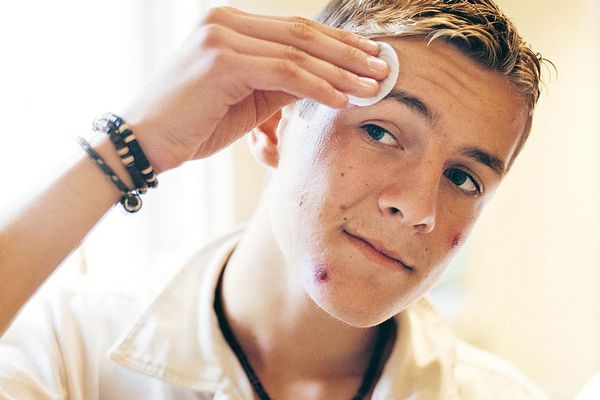 Medicamentos para tratamento da Acne